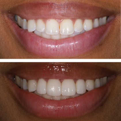 Minimal Prep Porcelain Veneers Ashley - Before