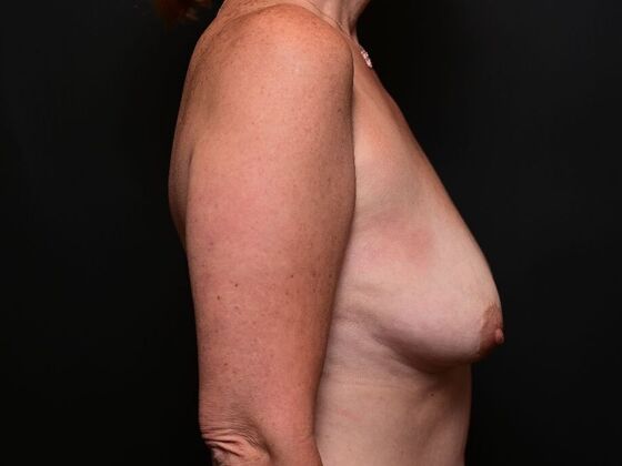 Breast Lift: Case 4 - Before