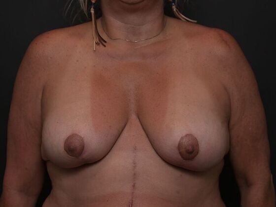 Breast Lift Case 6 - After