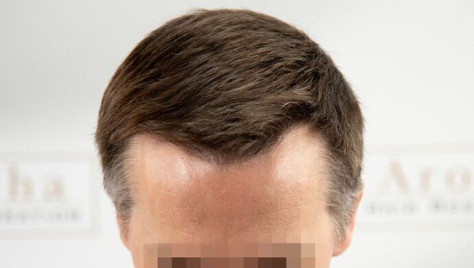 FUE Hair Restoration: Case 49 - After