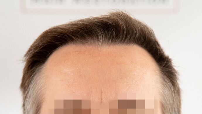 FUE Hair Restoration: Case 49 - After