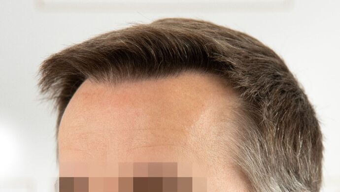 FUE Hair Restoration: Case 49 - After