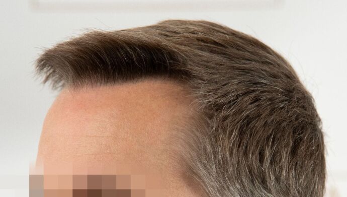 FUE Hair Restoration: Case 49 - After