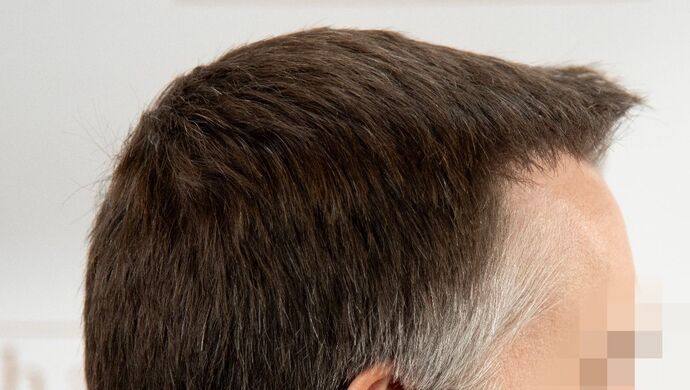 FUE Hair Restoration: Case 49 - After