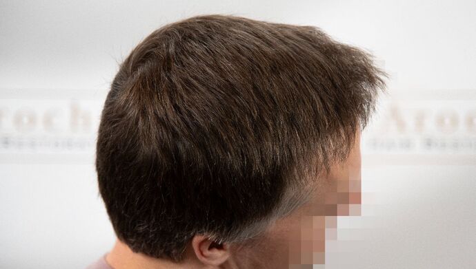 FUE Hair Restoration: Case 49 - After