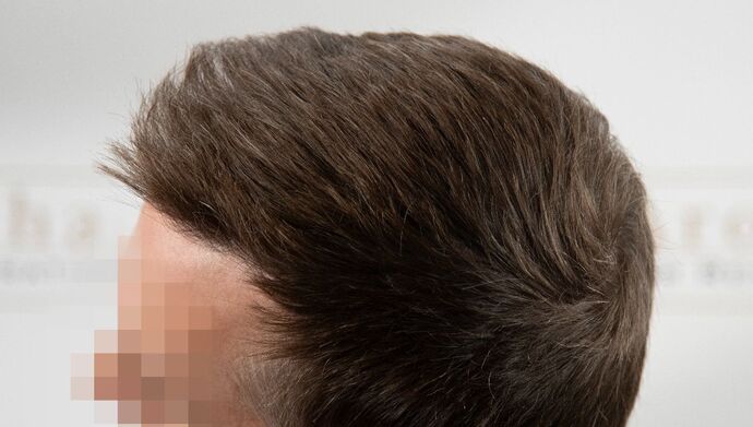 FUE Hair Restoration: Case 49 - After