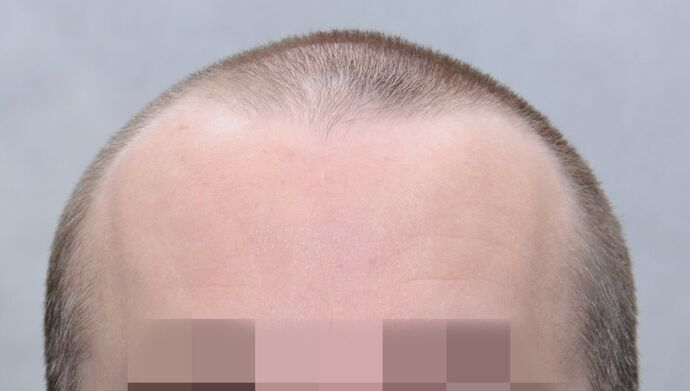 FUE Hair Restoration: Case 49 - Before