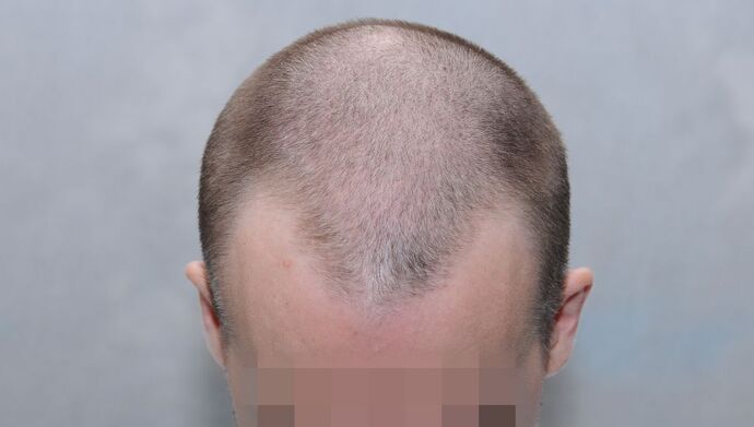 FUE Hair Restoration: Case 49 - Before