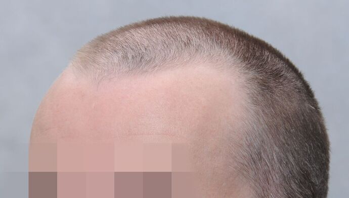 FUE Hair Restoration: Case 49 - Before