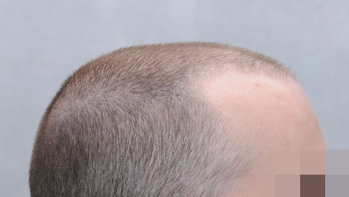 FUE Hair Restoration: Case 49 - Before