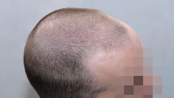 FUE Hair Restoration: Case 49 - Before