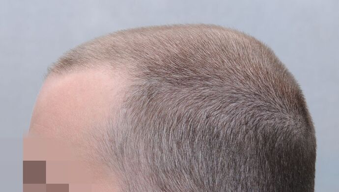 FUE Hair Restoration: Case 49 - Before