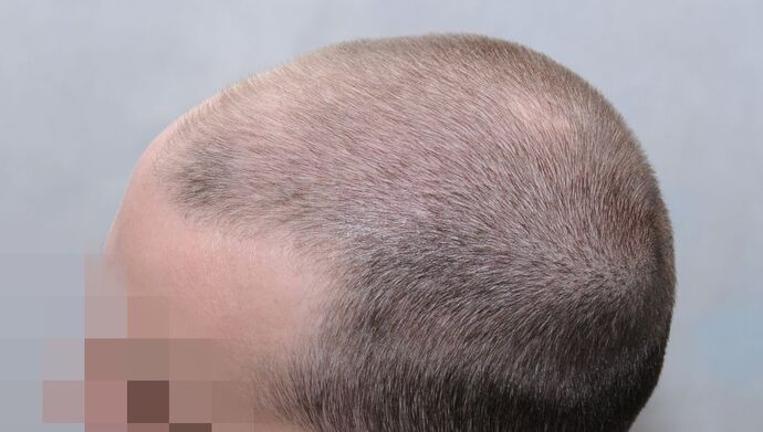 FUE Hair Restoration: Case 49 - Before