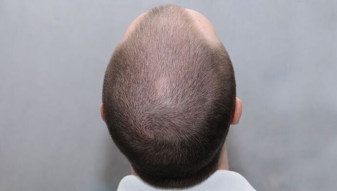 FUE Hair Restoration: Case 49 - Before