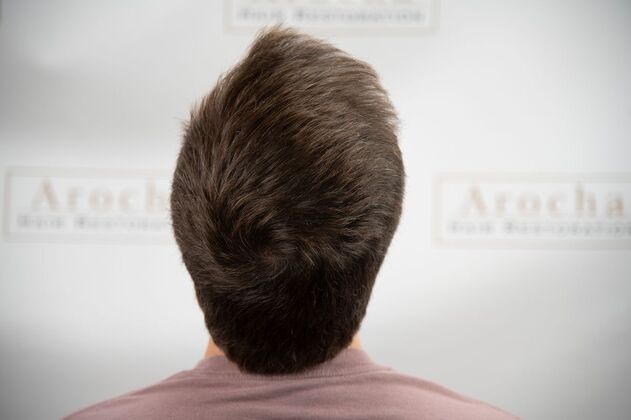 FUE Hair Restoration: Case 49 - After