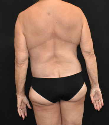 Massive Weight Loss Surgery: Case 1 - After