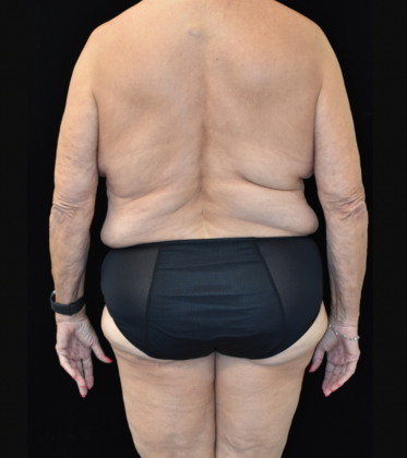 Massive Weight Loss Surgery: Case 1 - Before