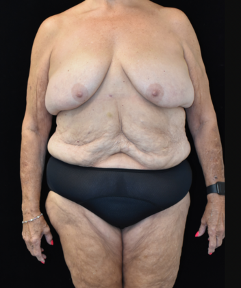 Massive Weight Loss Surgery Case 1 - Before