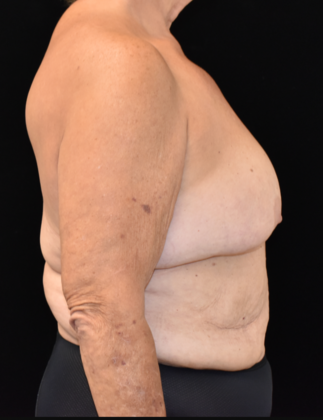 Massive Weight Loss Surgery: Case 1 - Before
