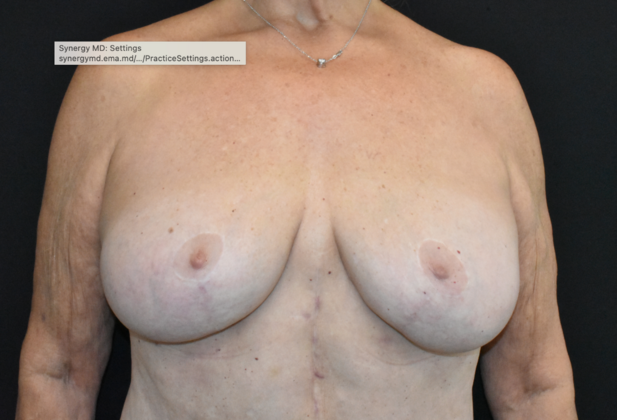 Mastopexy Case 9 - After