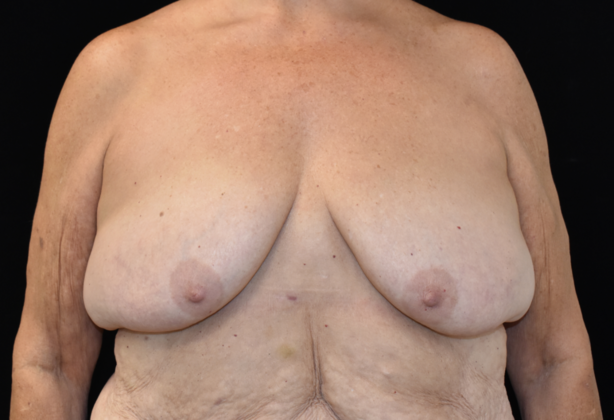 Mastopexy Case 9 - Before