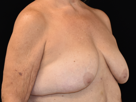 Mastopexy: Case 9 - Before