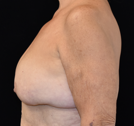 Mastopexy: Case 9 - Before