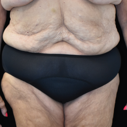 Abdominoplasty Case 25 - Before