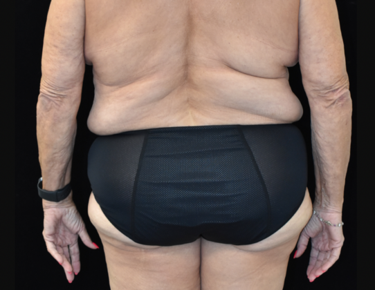 Abdominoplasty: Case 25 - Before