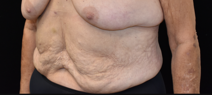 Abdominoplasty: Case 25 - Before