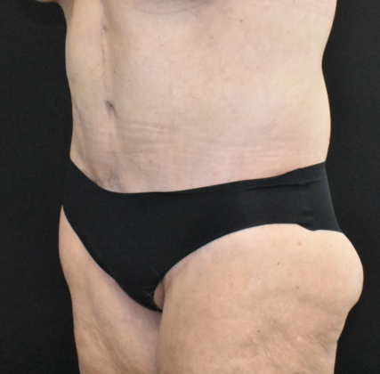 Abdominoplasty: Case 25 - After