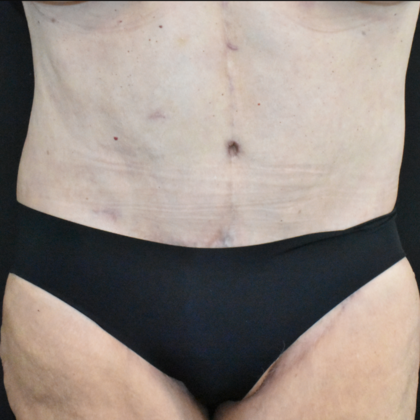 Abdominoplasty Case 25 - After
