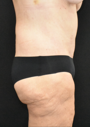 Abdominoplasty: Case 25 - After