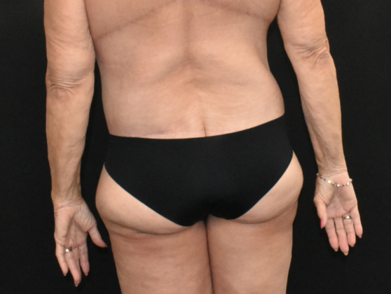 Abdominoplasty: Case 25 - After