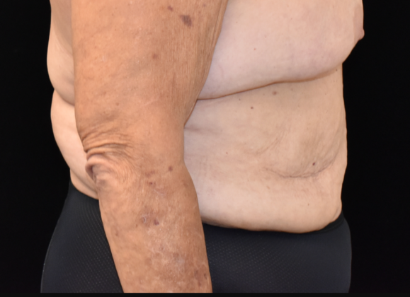 Abdominoplasty: Case 25 - Before