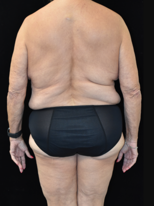 Torsoplasty: Case 5 - Before