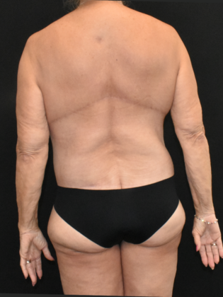 Torsoplasty: Case 5 - After