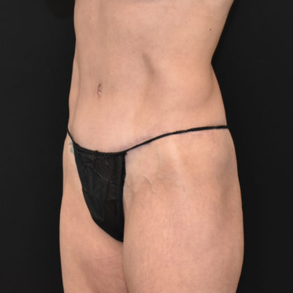 Abdominoplasty: Case 20 - After