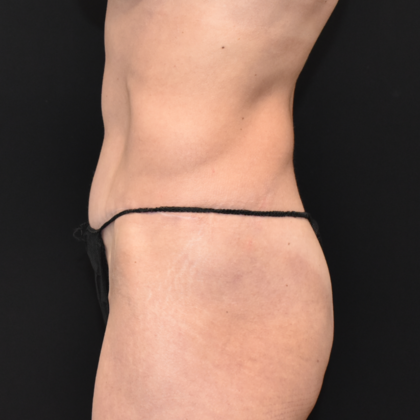 Abdominoplasty: Case 20 - After