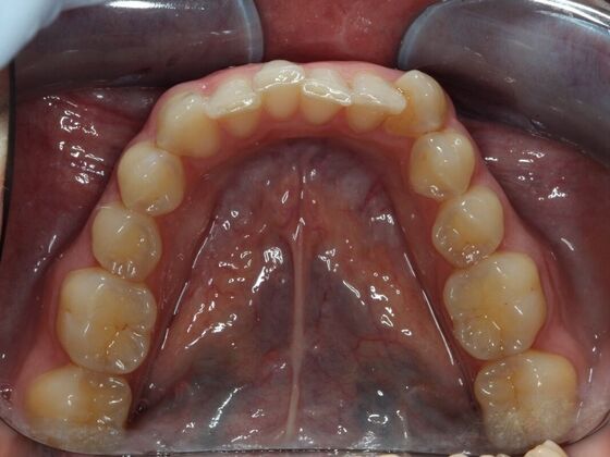 Invisalign Case 1 - Before