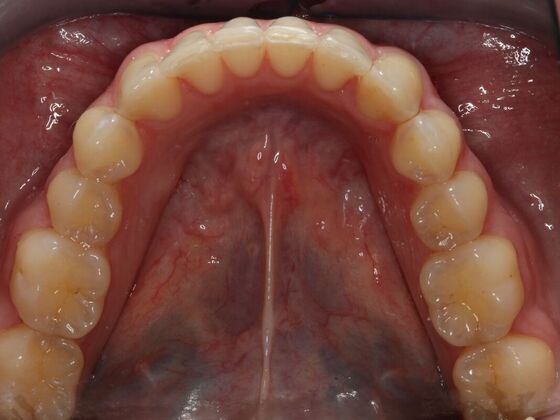 Invisalign Case 1 - After