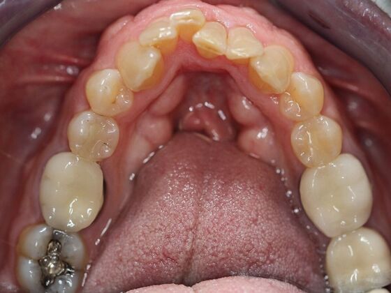Invisalign Case 2 - Before
