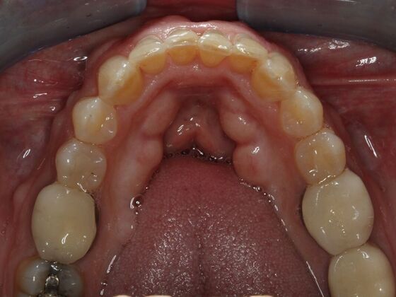Invisalign Case 2 - After