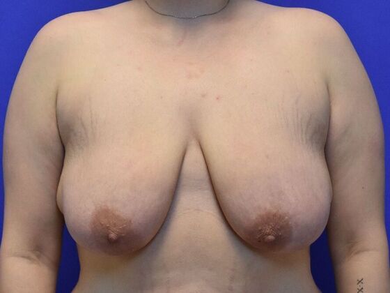 Breast Lift Case 8 - Before