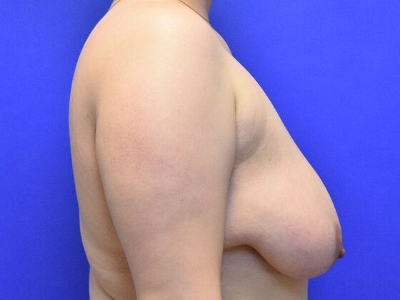 Breast Lift: Case 8 - Before