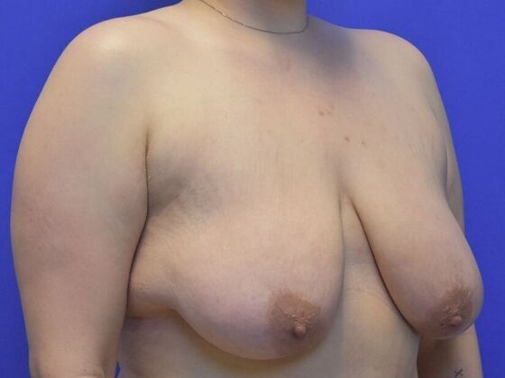 Breast Lift: Case 8 - Before
