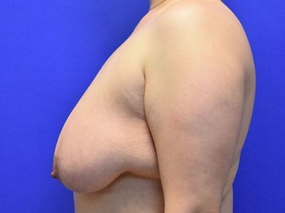 Breast Lift: Case 8 - Before