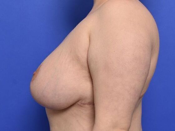 Breast Lift: Case 8 - After