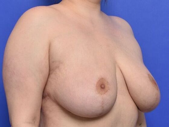 Breast Lift: Case 8 - After