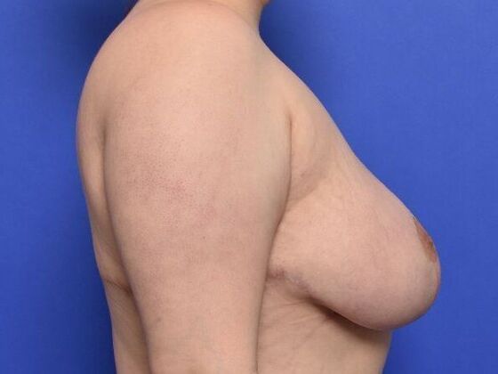 Breast Lift: Case 8 - After